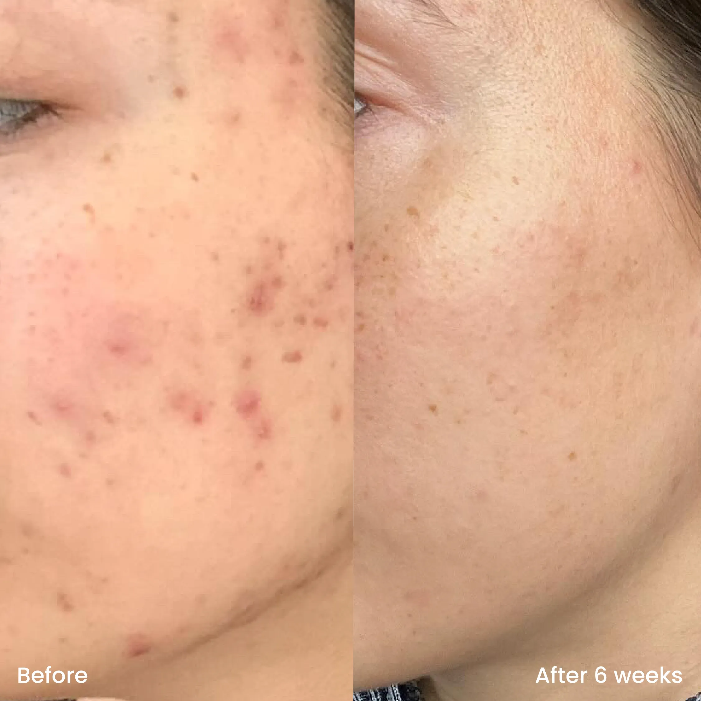 Oily skin set